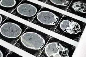 Funzione cerebrale e sezioni nella scansione MRI - Hub di alfabetizzazione sanitaria