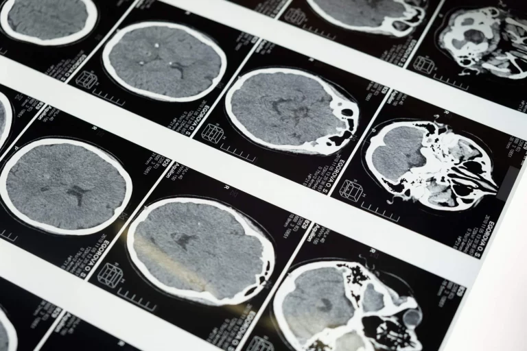 Brain Function and Sections in MRI Scans