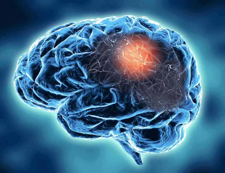 Grafico del cervello di sclerosi multipla - Hub di alfabetizzazione sanitaria