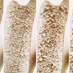 What are Osteoporosis Scans?