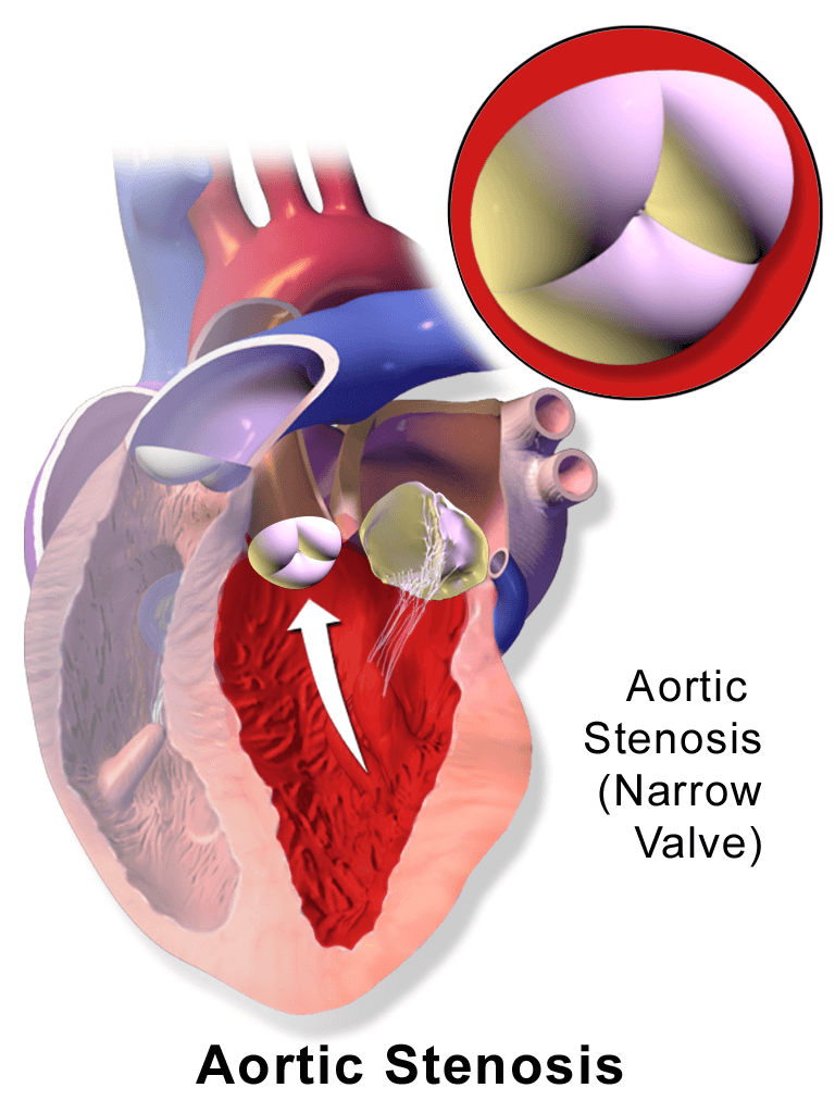 aortic-stenosis-explained-pathology-101-for-patients