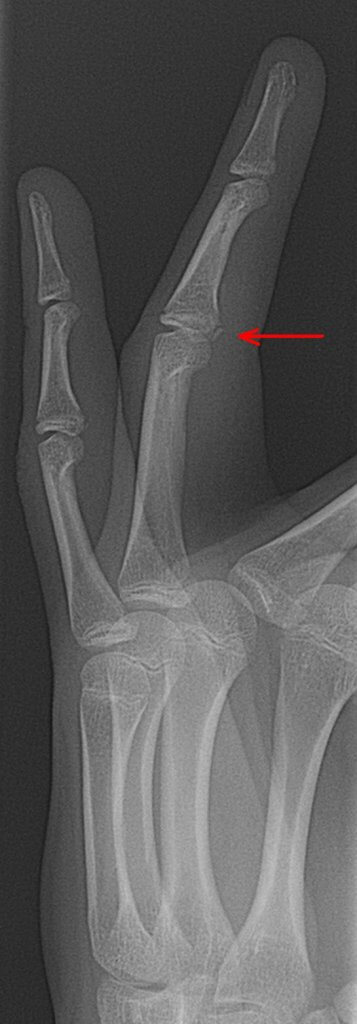 Avulsion Fractures Explained