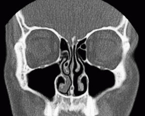 CTスキャンの冠状面で見た鼻甲介-ヘルスリテラシーハブ