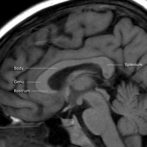 脳梁は、2つの脳半球間の効果的なコミュニケーションを可能にする繊維の束です。この記事では、その構造、機能、および最も一般的な病気について説明します。