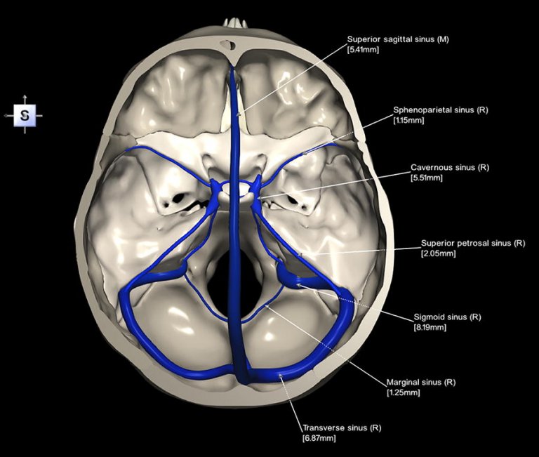 Cavernous Sinus Explained with XR view