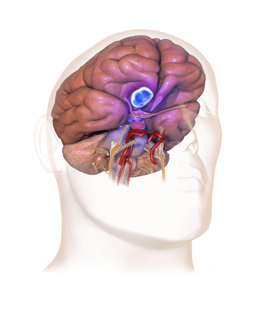 Meningioma – Tumor cerebral mais comum“/&gt;</a></div><div class=