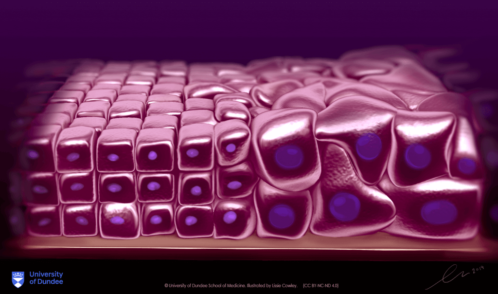 Oesophageal Dysplasia Explained