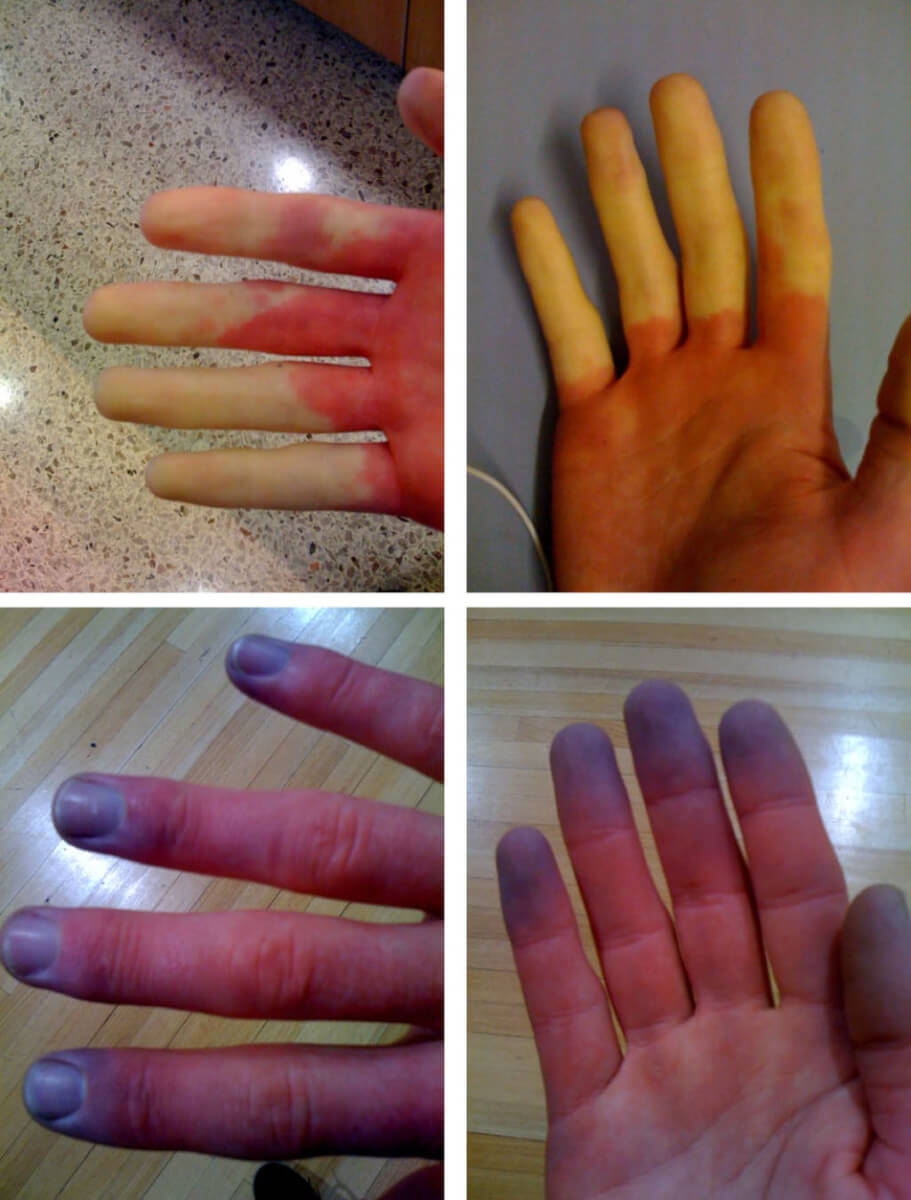 Raynaud'sSyndrom erklärt Pathologie 101 für Patienten
