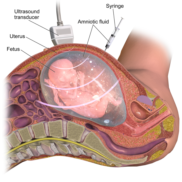 A Guide to an Amniocentesis Procedure