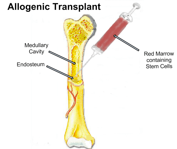 Bone Marrow Transplant: What You Must Know