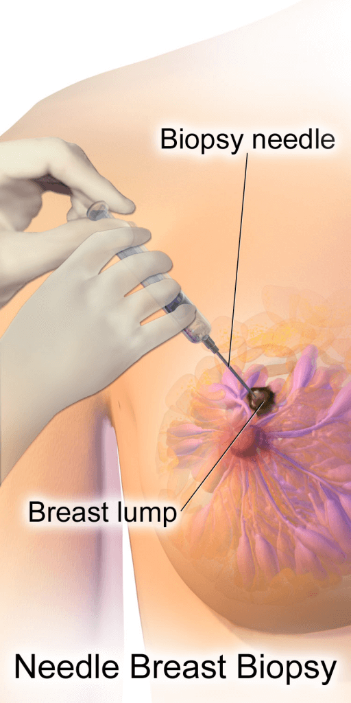 Breast Biopsy Surgery: What to Expect