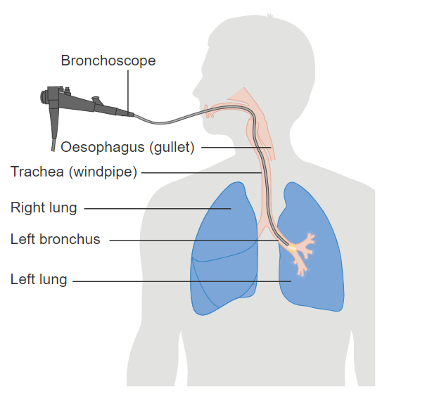 A Guide to a Bronchoscopy Procedure