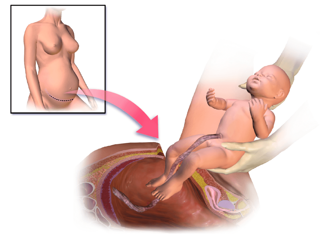 A Caesarean Section: The Facts
