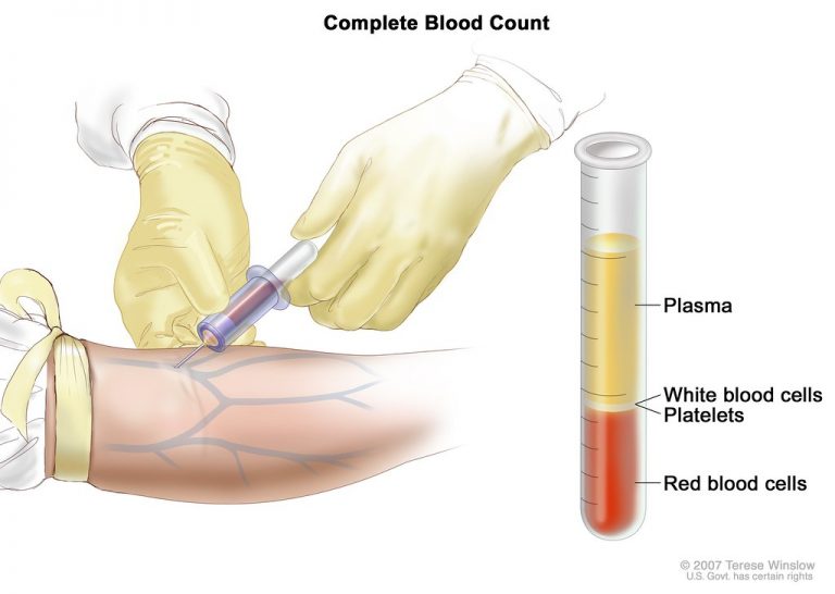 What Is a Complete Blood Count Test?