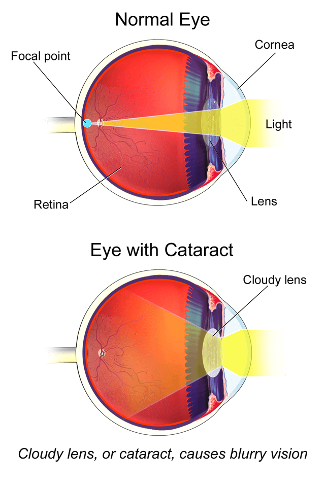 Cataract Surgery: Everything You Need to Know