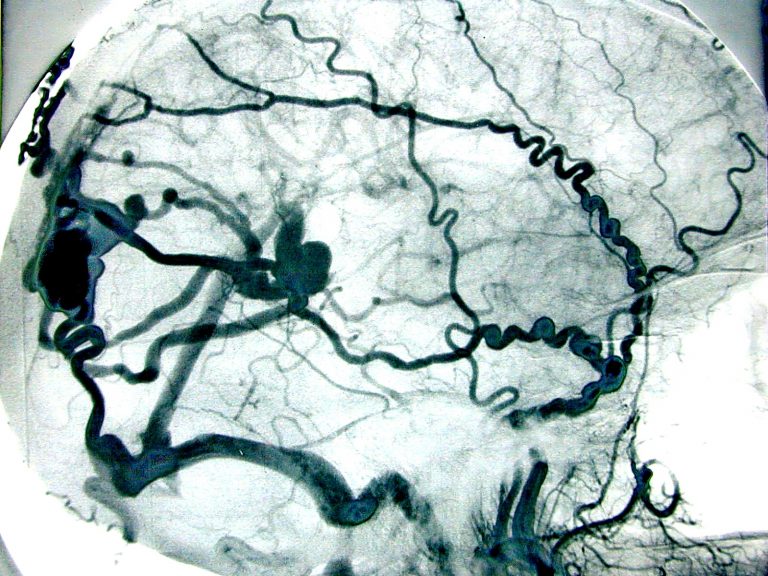Cerebral Angiography Procedure: What Does It Involve