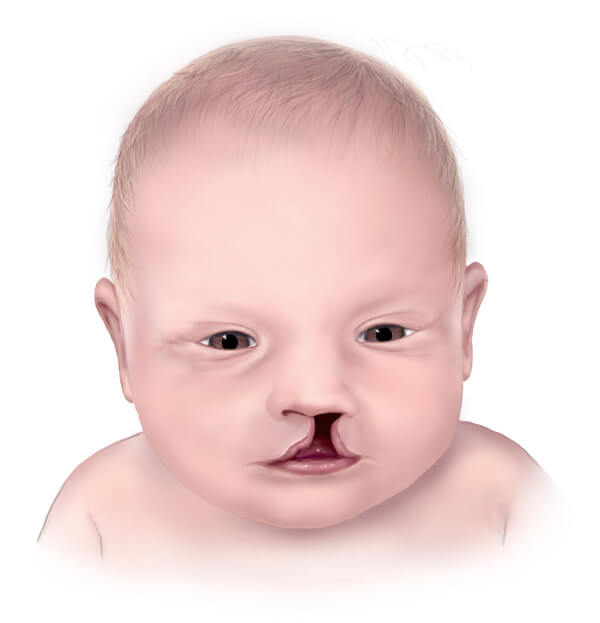 A Guide to Cleft Lip and Cleft Palate
