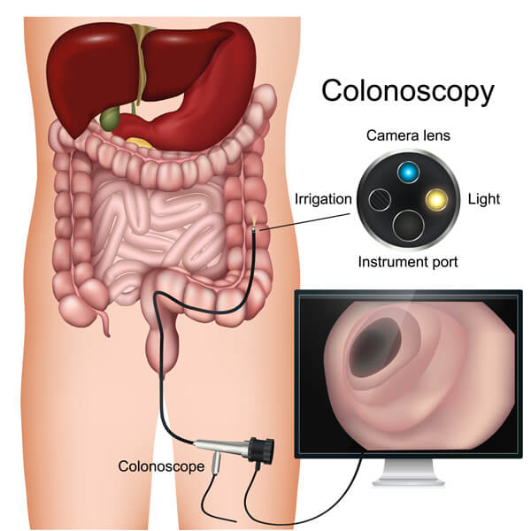 A Guide to a Colonoscopy Procedure
