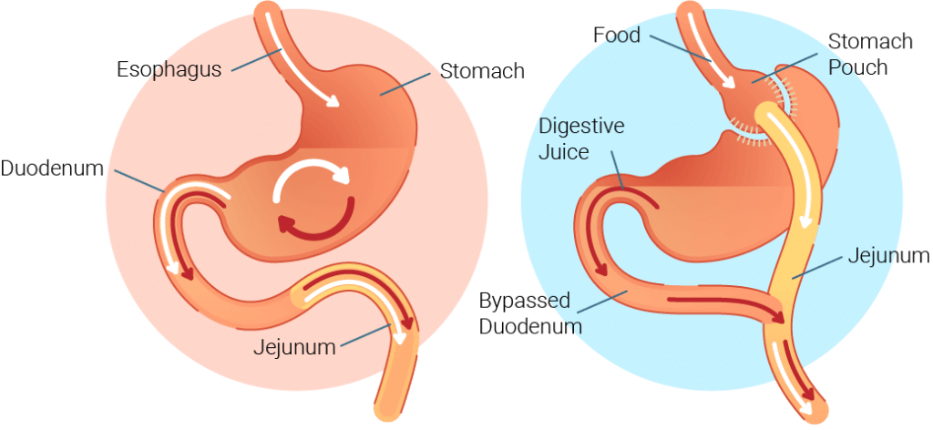 Gastric Bypass Surgery: Your Path to a Newer, Healthier You