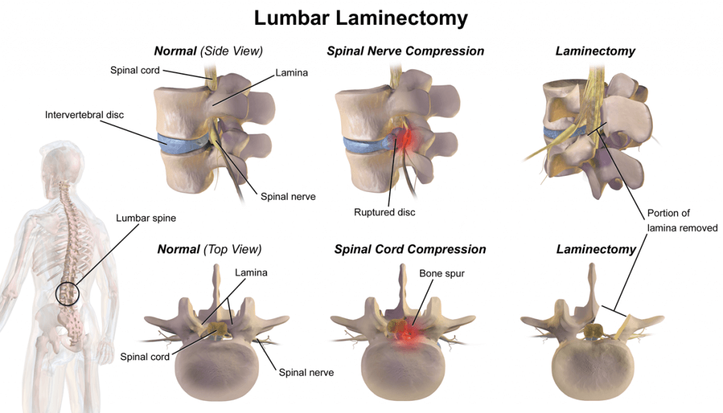 A Laminectomy: What Happens If Your Spine Becomes Compressed