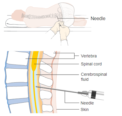 A Guide to a Lumbar Puncture Procedure