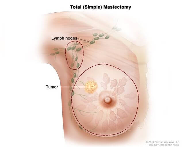 Breast Removal: What Happens During A Mastectomy
