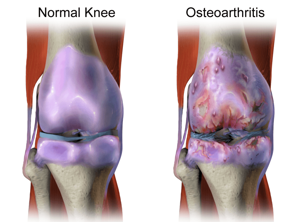A Guide to Osteoarthritis