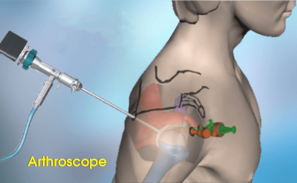 A Full Guide To An Arthroscopy