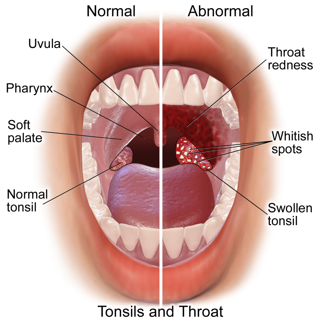 Tonsillectomy: A Guide To Getting Your Tonsils Removed