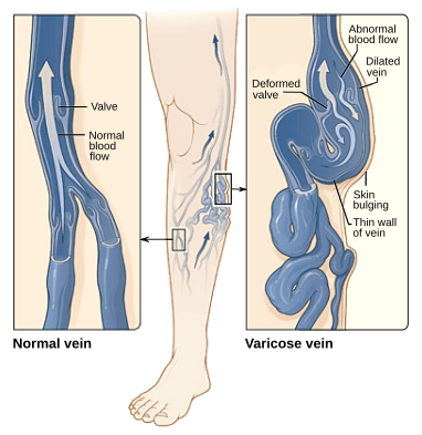 A Guide to Varicose Veins