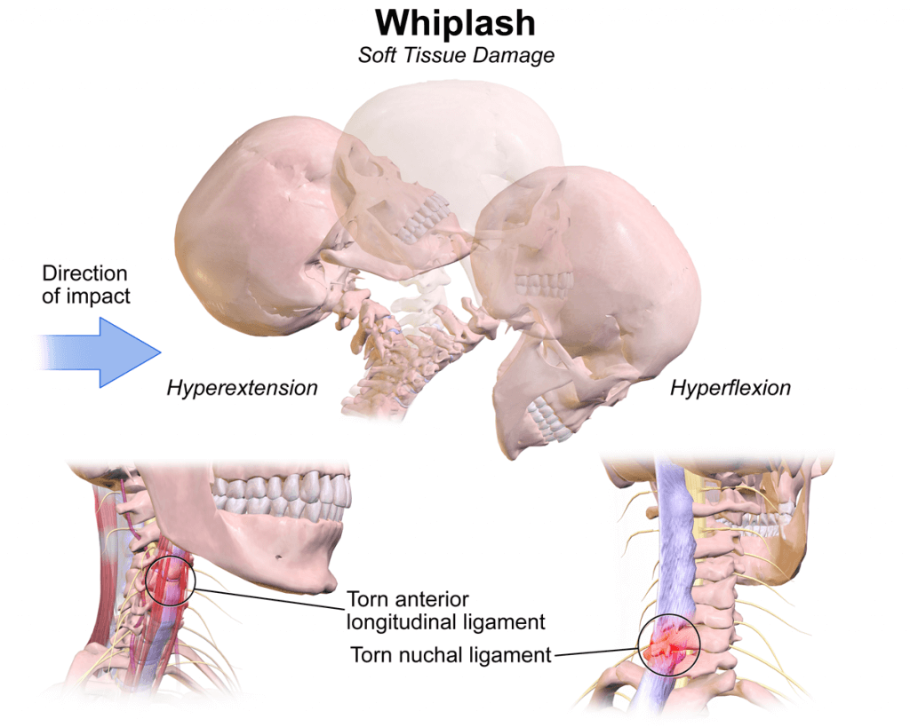 Whiplash: The Effects On The Body