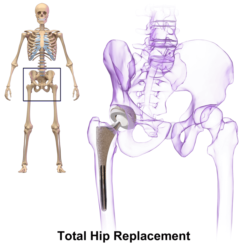 A Hip Replacement: Essential Information and Facts