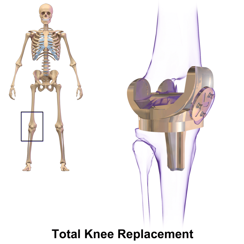 Knee Replacement Surgery: What You Need To Know