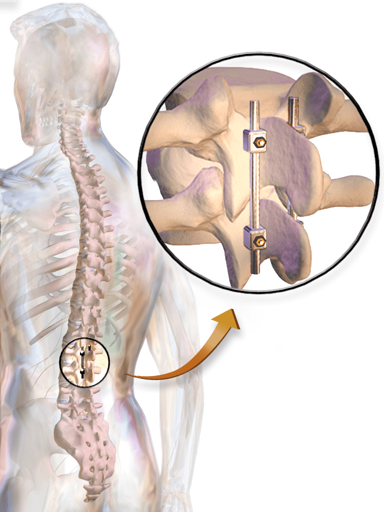 Spinal Fusion: The Facts