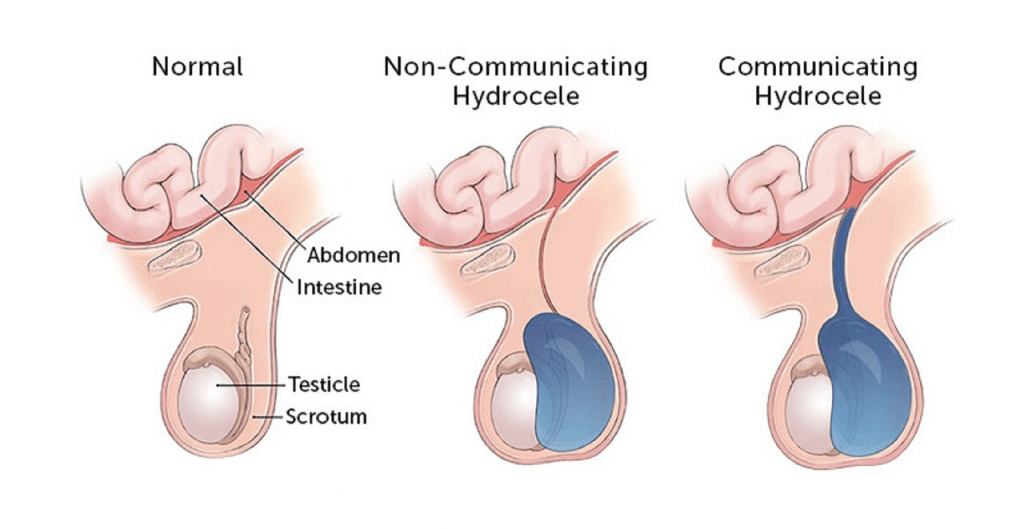 What Is a Hydrocele?