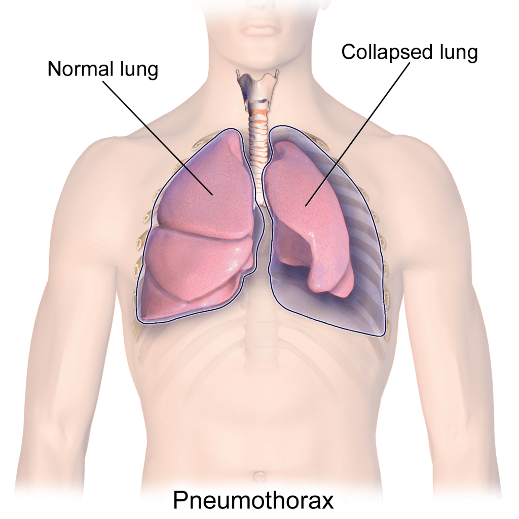 Pulmonary Collapse: What you Should Know