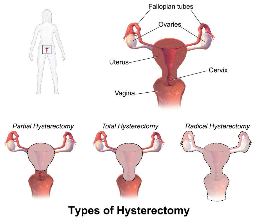 A Comprehensive Guide to Hуѕtеrесtоmу Surgery