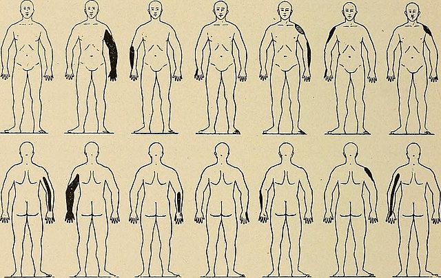 Locations of erbs palsy