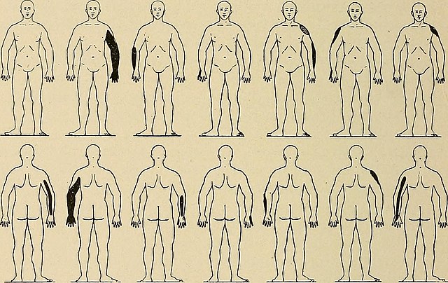 Erb's Palsy के बारे में सब कुछ&quot;/&gt;</a></div><div class=