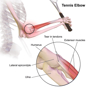 Tennis elbow diagnosis