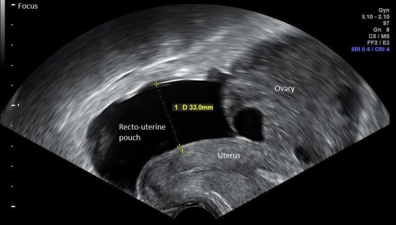 Ergebnisse des vaginalen Ultraschalls