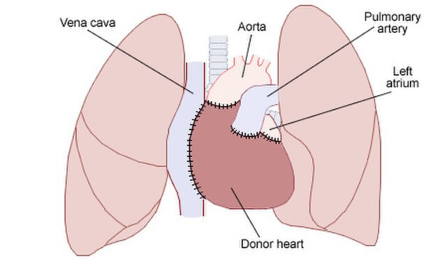 Heart transplant diagram