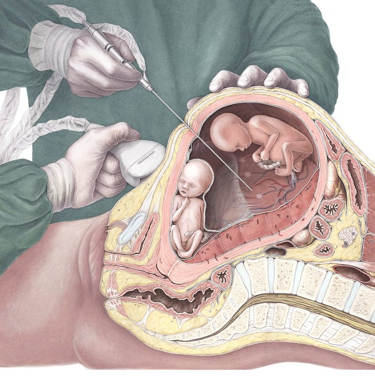 胎児レーザー手術