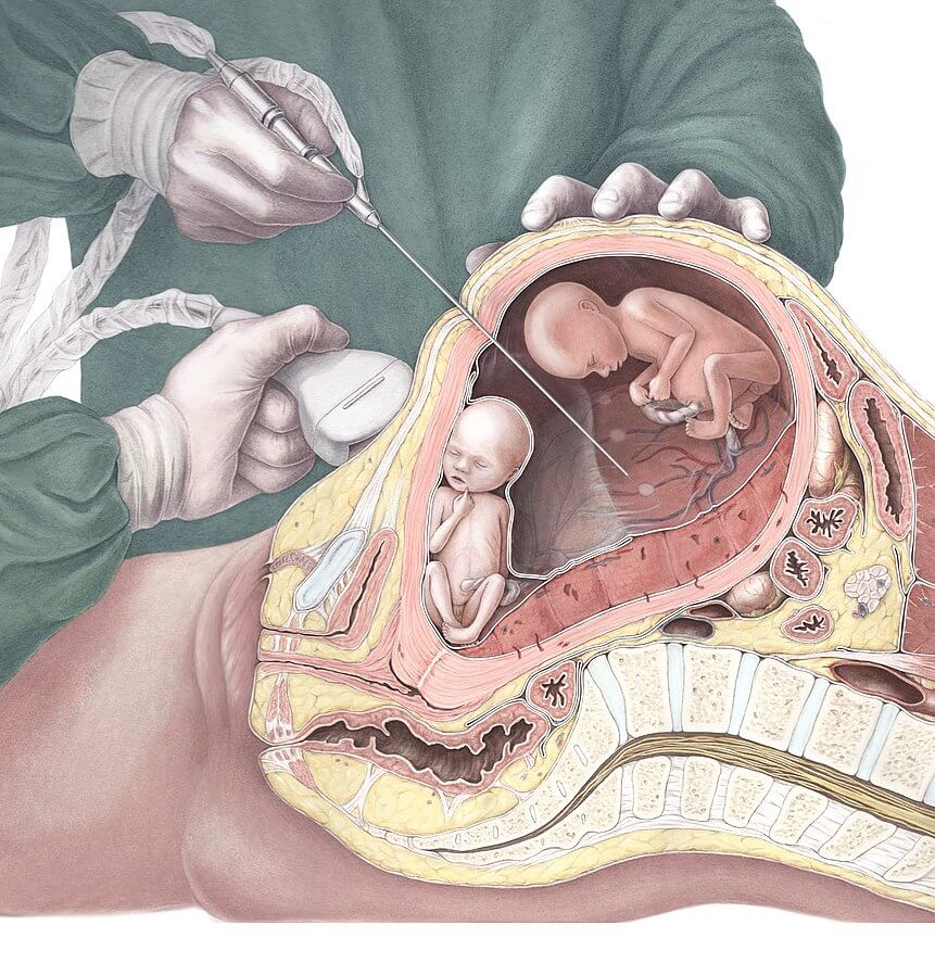 What Happens During Fetal Surgery?