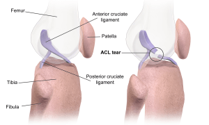 ACL 撕裂位置