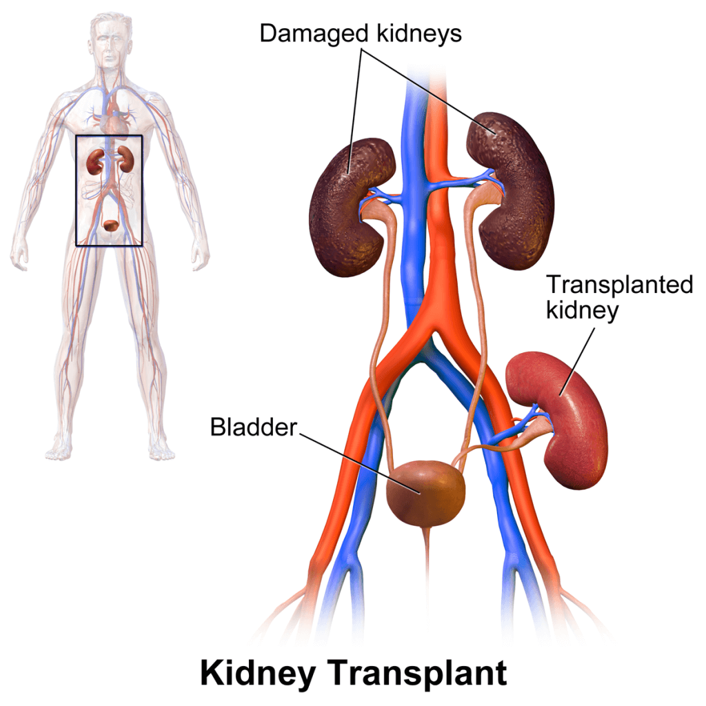 All The Facts About a Kidney Transplant